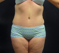 Manhattan abdominoplasty after 17